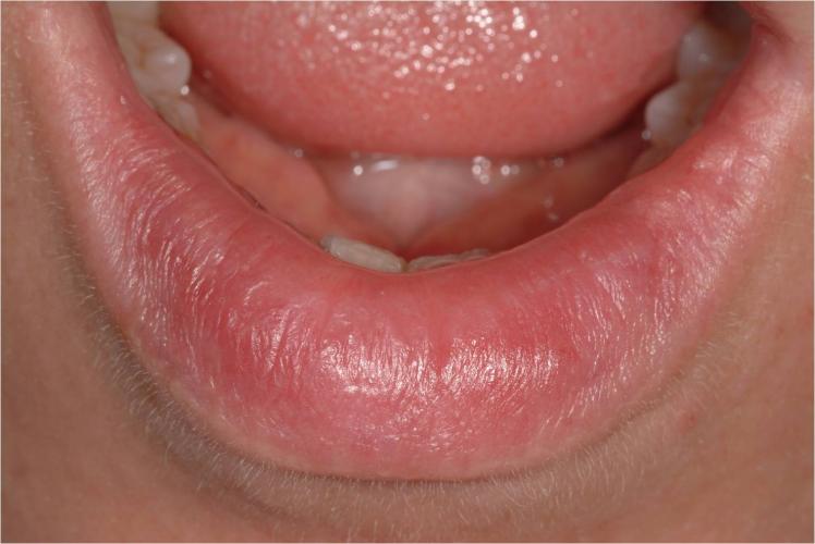 cracked bleeding lips